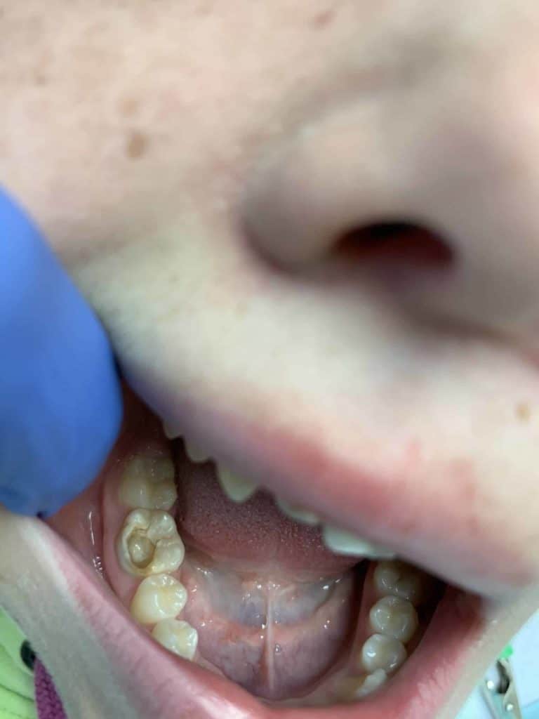 Root Canal Treatment And Filling - Before